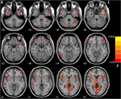 Multiple-Network Alterations in Major Depressive Disorder With Gastrointestinal Symptoms at Rest Revealed by Global Functional Connectivity Analysis